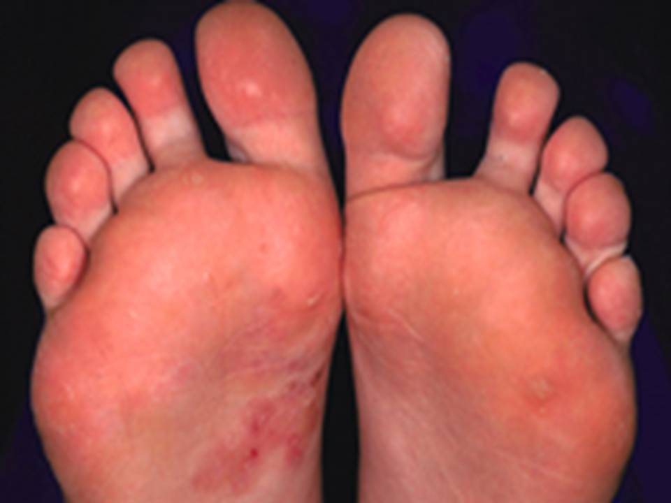 dry scaly feet fungus