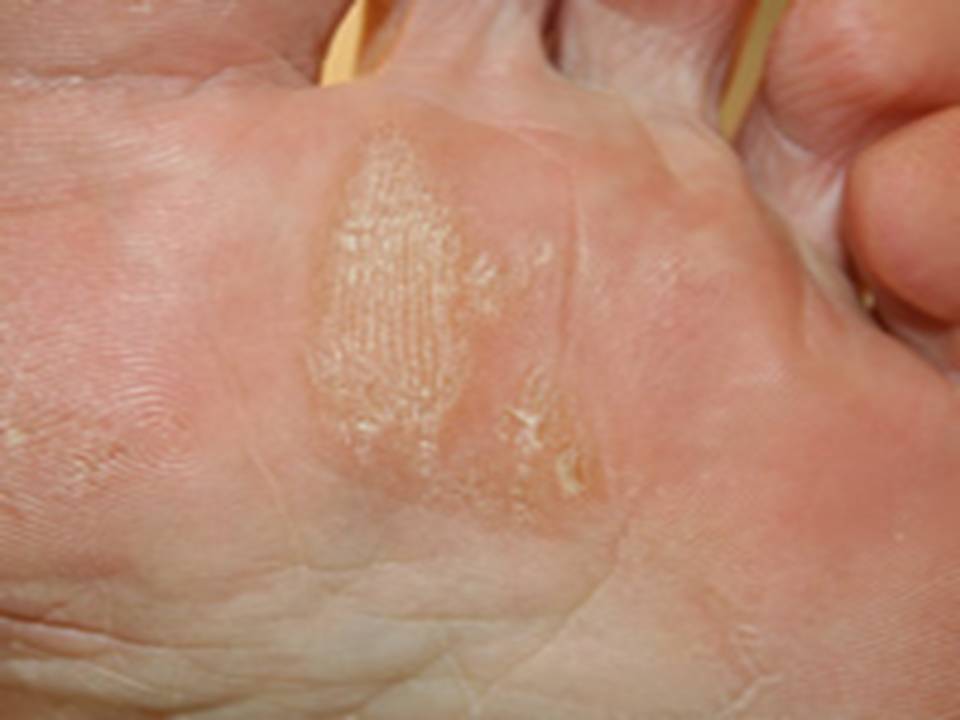 hard skin on ball of foot removal