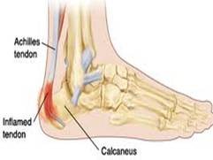 growing pains in achilles tendon