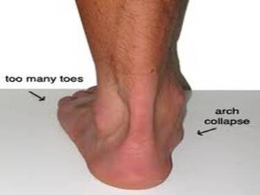 Flat feet / fallen arches | What are 