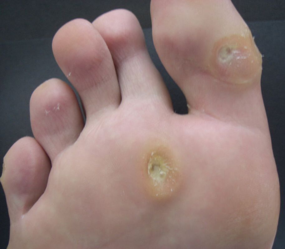 calluses on ball of foot