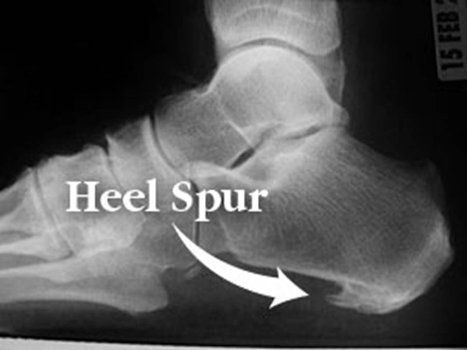 Heel Spur Problem Calcaneal Bone Condition Stock Vector (Royalty Free)  2161004819 | Shutterstock
