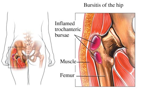 hip bursitis2 orig